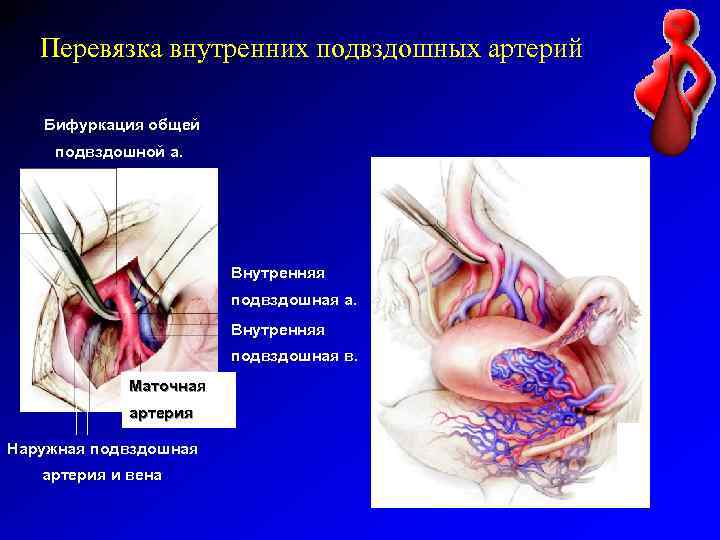 Перевязка внутренних подвздошных артерий Бифуркация общей подвздошной а. Внутренняя подвздошная а. а Внутренняя подвздошная