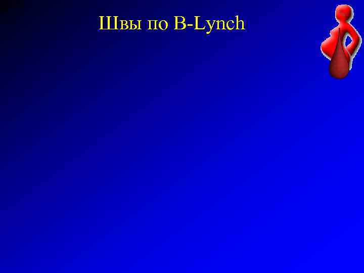 Швы по B-Lynch 