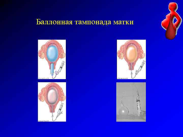 Баллонная тампонада матки 