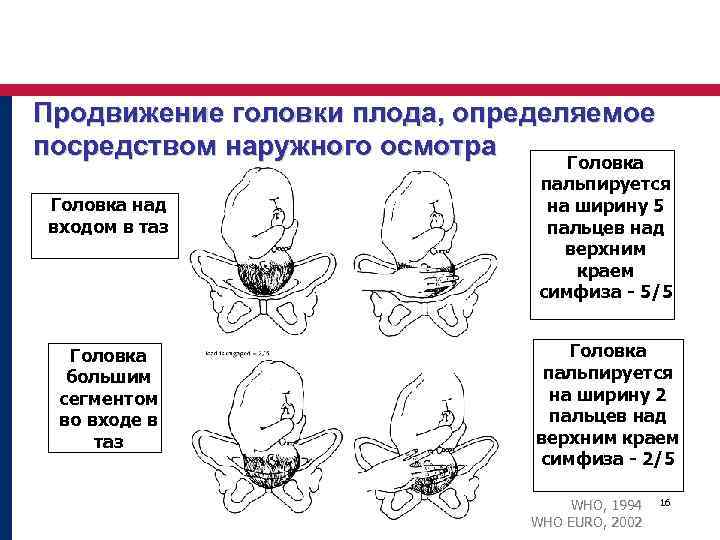 Продвижение головки плода, определяемое посредством наружного осмотра Головка над входом в таз Головка большим
