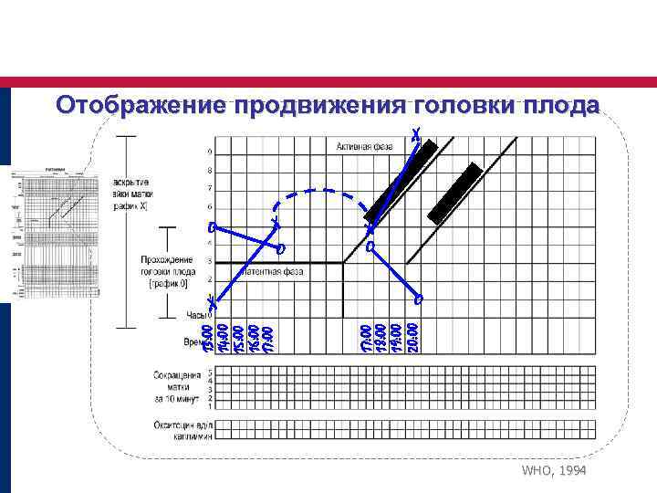 Отображение продвижения головки плода X X O 13: 00 14: 00 15: 00 16: