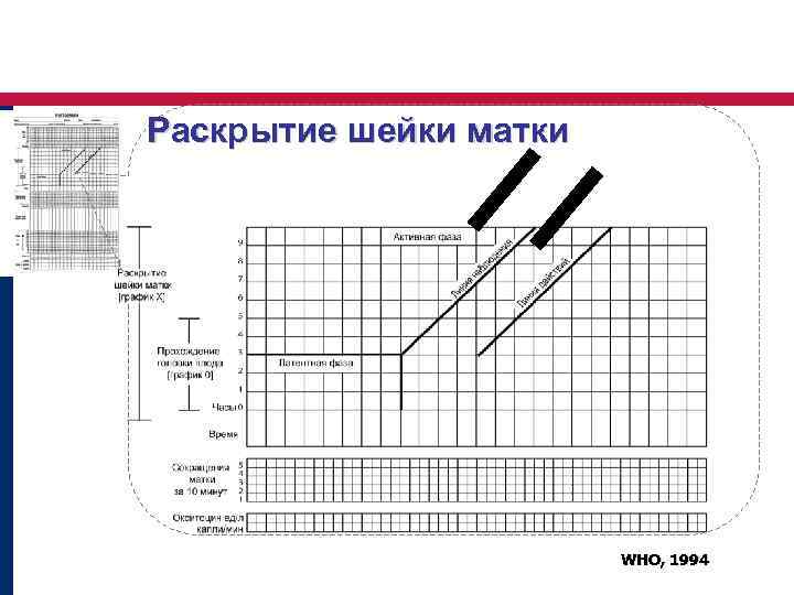 Раскрытие шейки матки WHO, 1994 