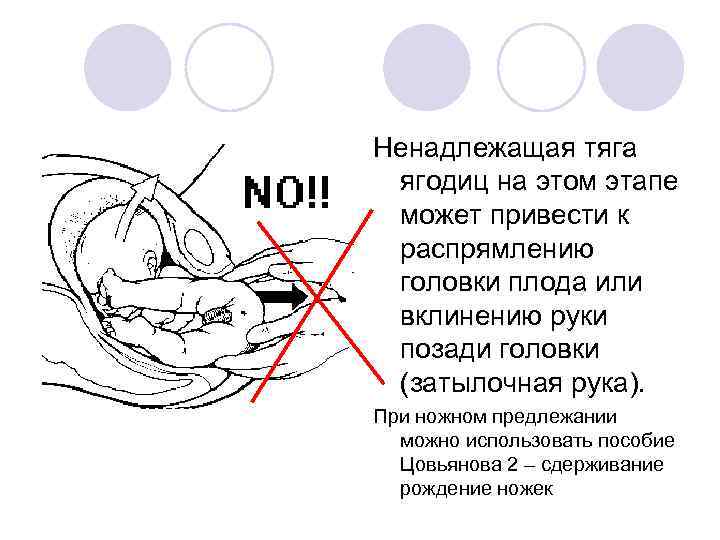 Ненадлежащая тяга ягодиц на этом этапе может привести к распрямлению головки плода или вклинению