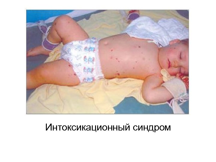 Интоксикационный синдром 