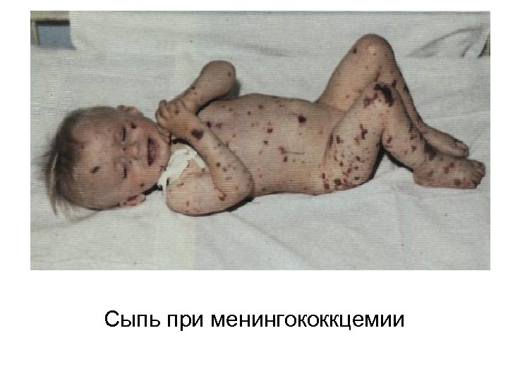 Сыпь при менингококкцемии 