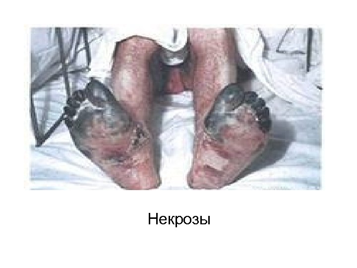 Некрозы 