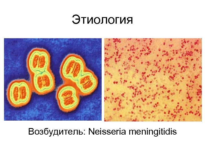 Этиология Возбудитель: Neisseria meningitidis 