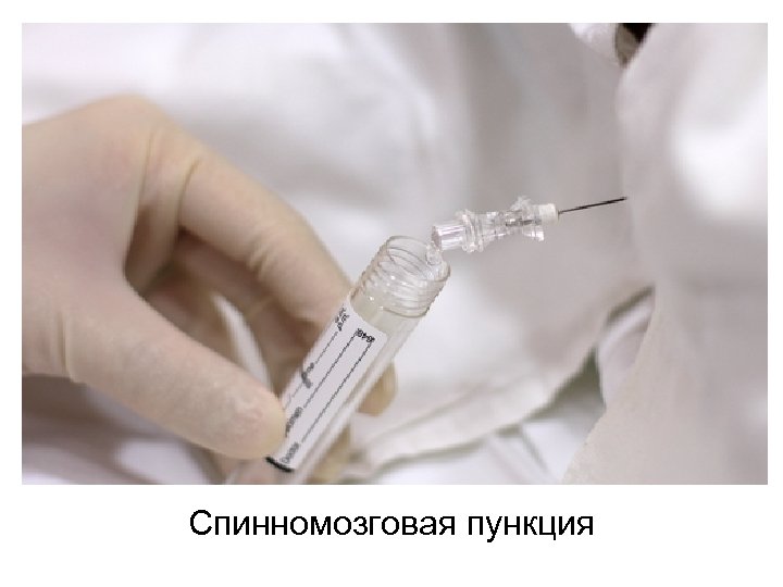 Спинномозговая пункция 