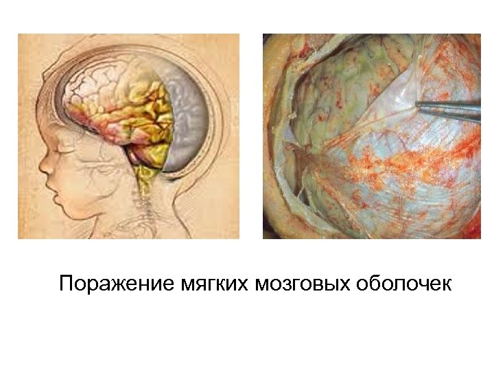 Поражение мягких мозговых оболочек 
