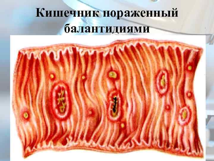 Кишечник пораженный балантидиями 