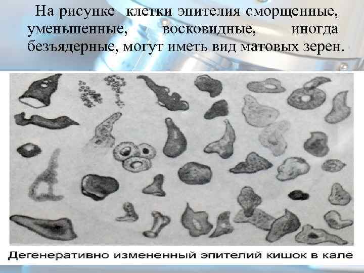  На рисунке клетки эпителия сморщенные, уменьшенные, восковидные, иногда безъядерные, могут иметь вид матовых