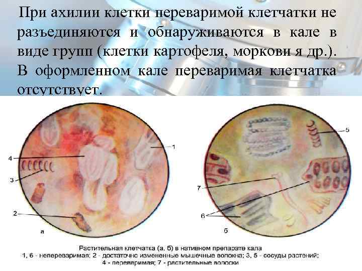 При ахилии клетки переваримой клетчатки не разъединяются и обнаруживаются в кале в виде групп