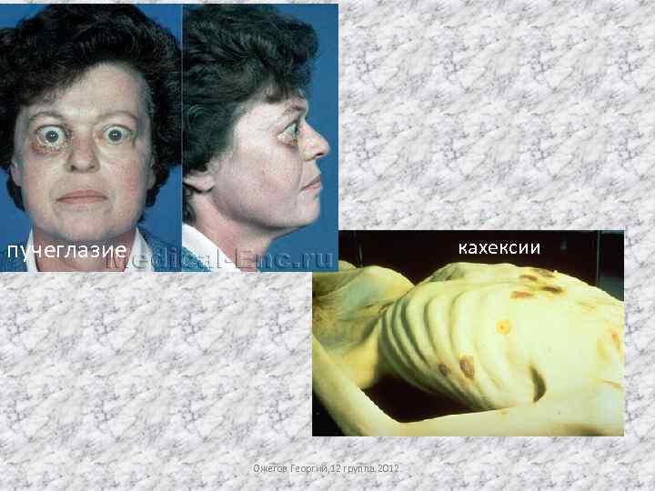 пучеглазие кахексии Ожегов Георгий, 12 группа. 2012. 