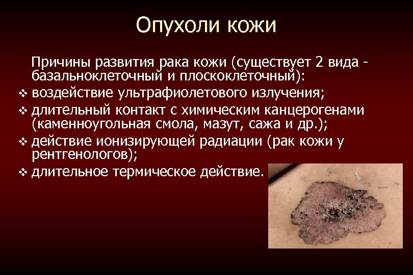 Опухоли кожи Причины развития рака кожи (существует 2 вида - базальноклеточный и плоскоклеточный): v