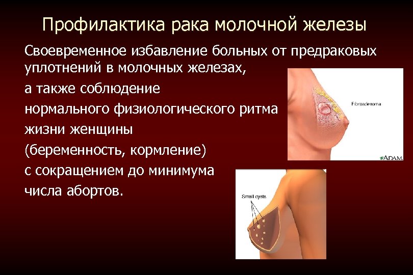 Профилактика рака молочной железы Своевременное избавление больных от предраковых уплотнений в молочных железах, а