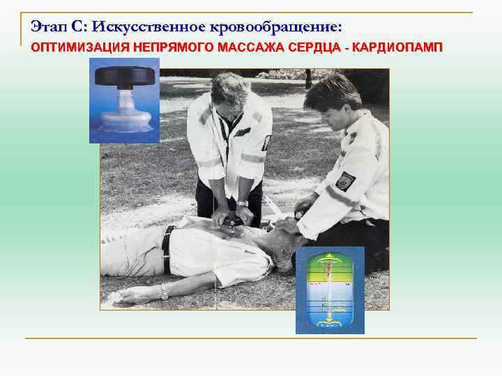Этап С: Искусственное кровообращение: ОПТИМИЗАЦИЯ НЕПРЯМОГО МАССАЖА СЕРДЦА - КАРДИОПАМП 