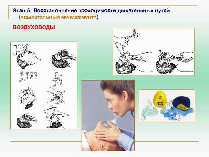 Этап А: Восстановление проходимости дыхательных путей ( «дыхательный менеджмент» ) ВОЗДУХОВОДЫ 