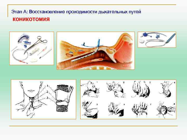 Этап А: Восстановление проходимости дыхательных путей КОНИКОТОМИЯ 