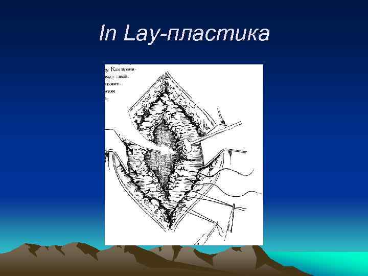 In Lay-пластика 