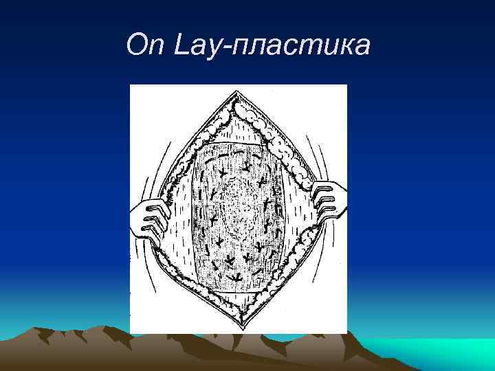 On Lay-пластика 