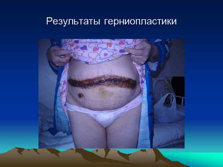 Результаты герниопластики 