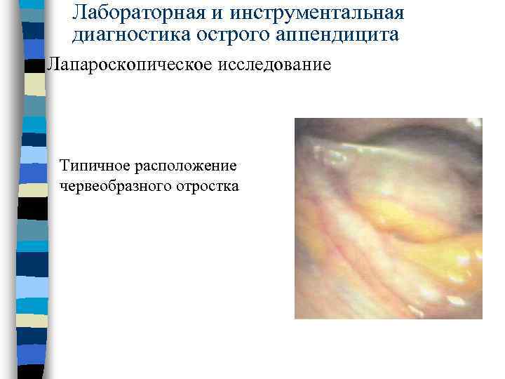 Особенности клинической картины острого аппендицита при тазовом расположении червеобразного отростка