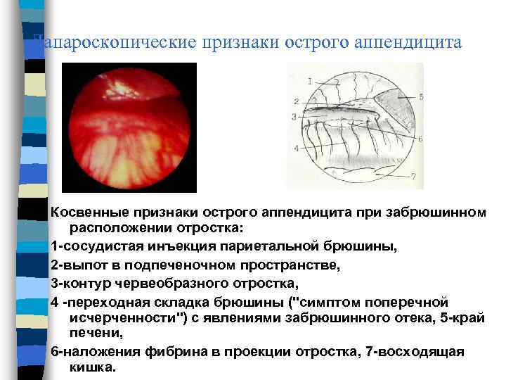 Лапароскопические признаки острого аппендицита Косвенные признаки острого аппендицита при забрюшинном расположении отростка: 1 -сосудистая