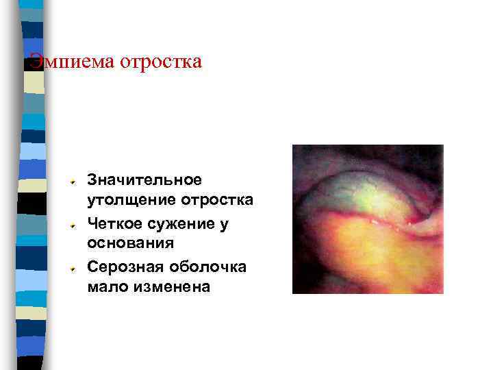 Эмпиема отростка Значительное утолщение отростка Четкое сужение у основания Серозная оболочка мало изменена 