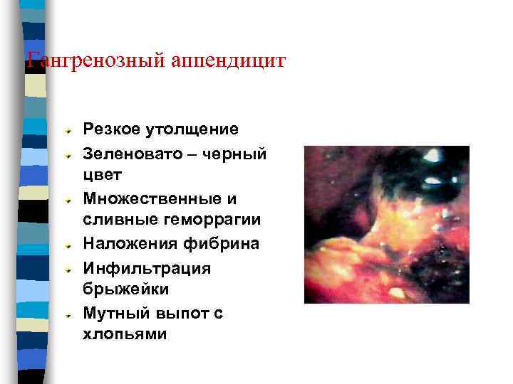 Гангренозный аппендицит Резкое утолщение Зеленовато – черный цвет Множественные и сливные геморрагии Наложения фибрина