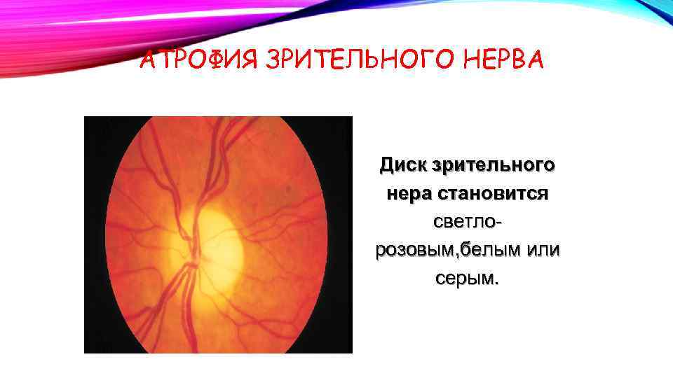 АТРОФИЯ ЗРИТЕЛЬНОГО НЕРВА Диск зрительного нера становится светлорозовым, белым или серым. 