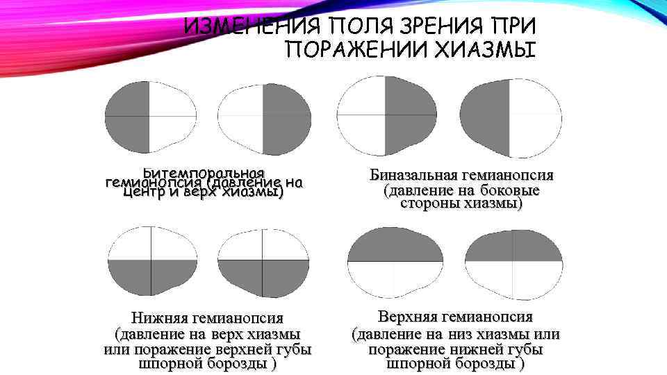 ИЗМЕНЕНИЯ ПОЛЯ ЗРЕНИЯ ПРИ ПОРАЖЕНИИ ХИАЗМЫ Битемпоральная гемианопсия (давление на центр и верх хиазмы)