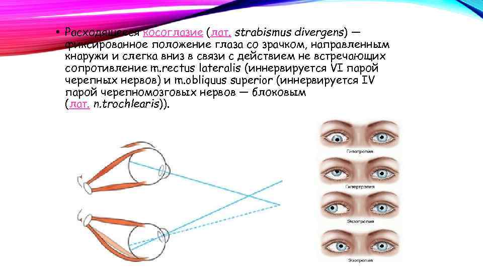  • Расходящееся косоглазие (лат. strabismus divergens) — фиксированное положение глаза со зрачком, направленным