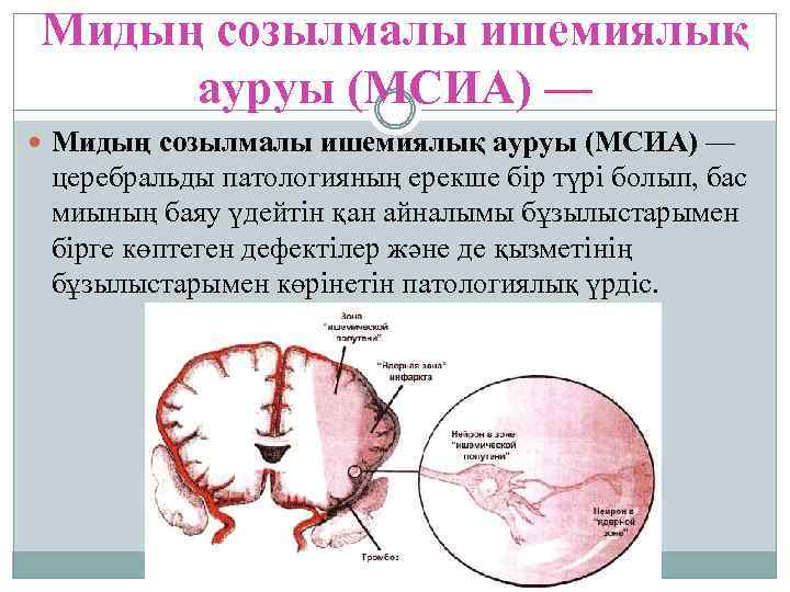 Мидың созылмалы ишемиялық ауруы (МСИА) — церебральды патологияның ерекше бір түрі болып, бас миының