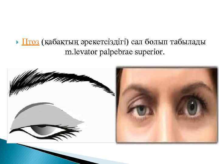  Птоз (қабақтың әрекетсіздігі) сал болып табылады m. levator palpebrae superior. 