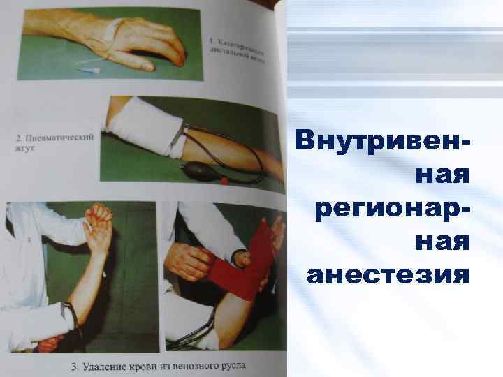 Внутривенная регионарная анестезия 