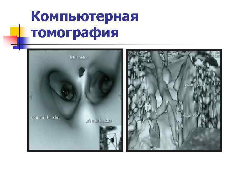 Компьютерная томография 