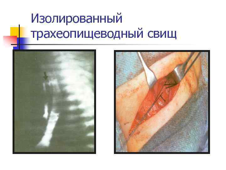 Изолированный трахеопищеводный свищ 