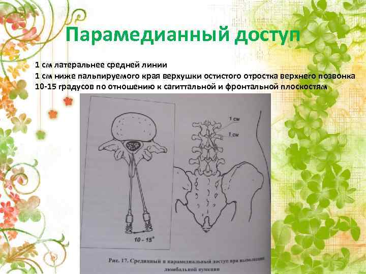 Парамедианный доступ 1 см латеральнее средней линии 1 см ниже пальпируемого края верхушки остистого