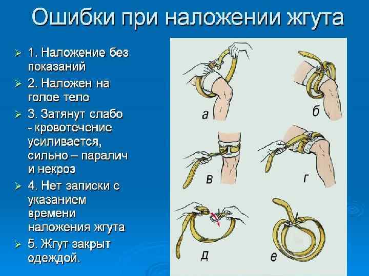 Ошибки при наложении жгута 