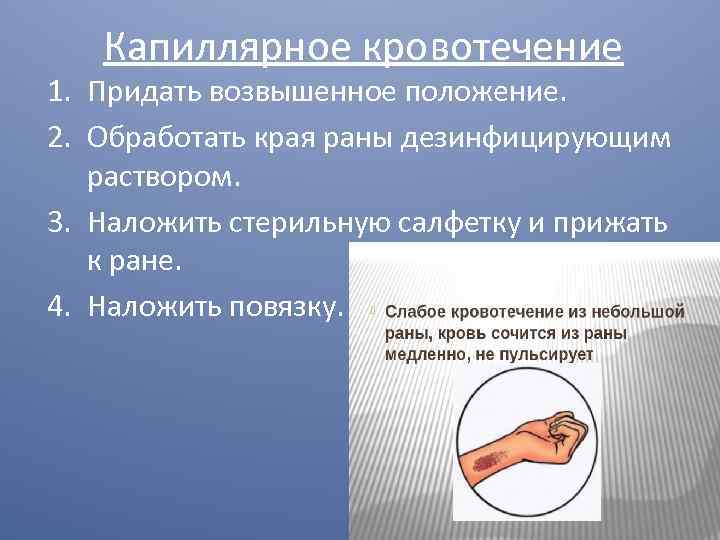 Капиллярное кровотечение 1. Придать возвышенное положение. 2. Обработать края раны дезинфицирующим раствором. 3. Наложить