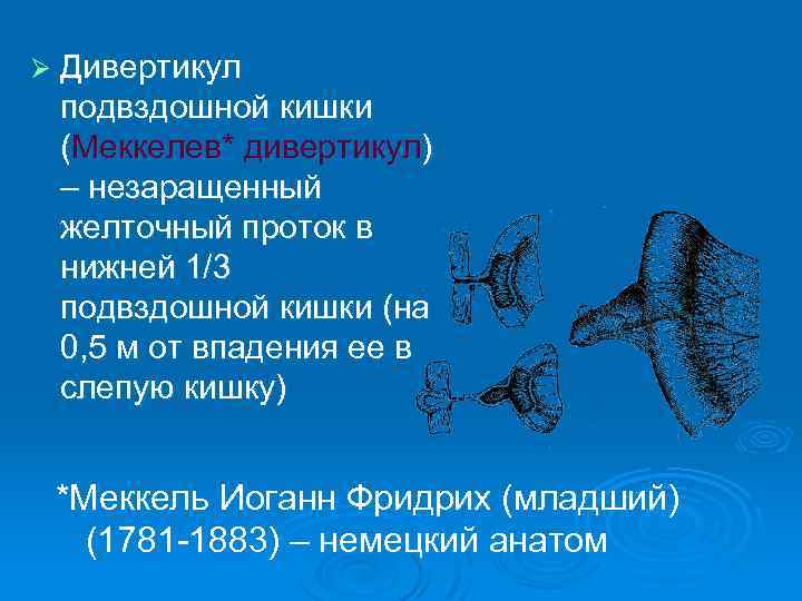 Ø Дивертикул подвздошной кишки (Меккелев* дивертикул) – незаращенный желточный проток в нижней 1/3 подвздошной