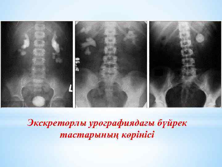 Экскреторлы урографиядағы бүйрек тастарының көрінісі 