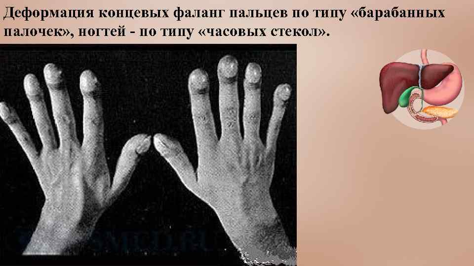 Деформация концевых фаланг пальцев по типу «барабанных палочек» , ногтей - по типу «часовых