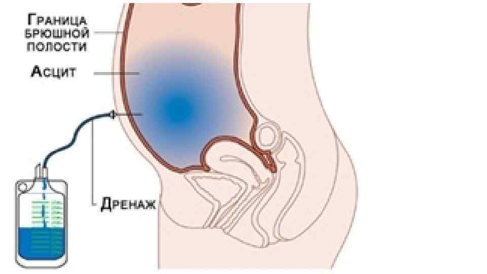 Цирроз печени лекция для медсестер