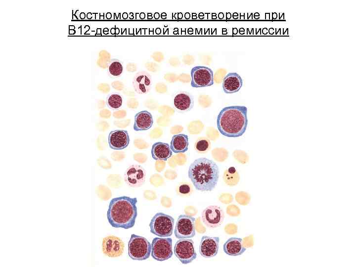 Костномозговое кроветворение при В 12 -дефицитной анемии в ремиссии 