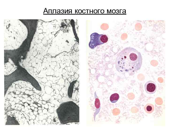 Аплазия костного мозга 