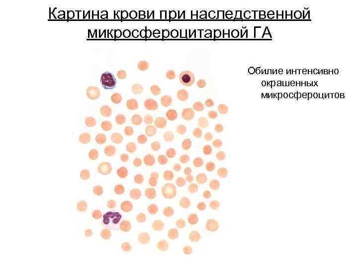 Картина крови при наследственной микросфероцитарной ГА Обилие интенсивно окрашенных микросфероцитов 