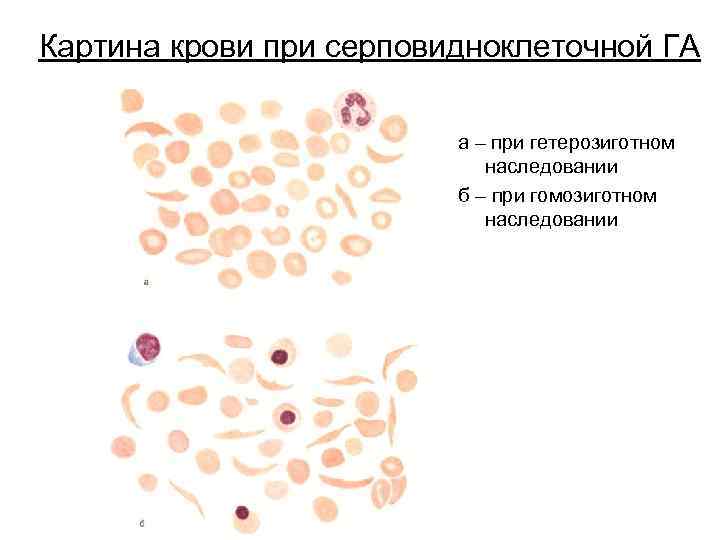 Картина крови при серповидноклеточной ГА а – при гетерозиготном наследовании б – при гомозиготном