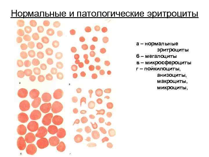 Нормальные и патологические эритроциты а – нормальные эритроциты б – мегалоциты в – микросфероциты