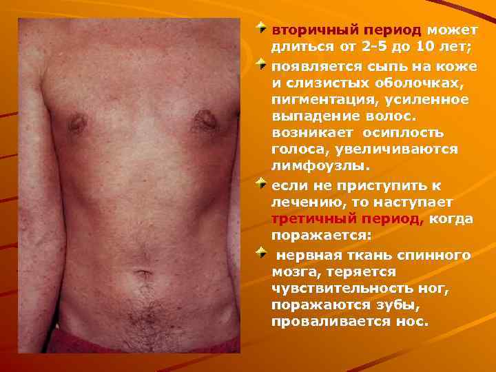 вторичный период может длиться от 2 -5 до 10 лет; появляется сыпь на коже